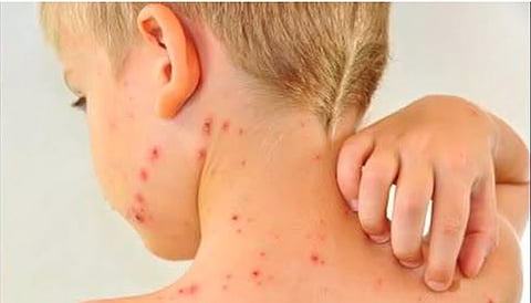 கேரளத்தில் 75 நாள்களில் 6,744 பேருக்கு அம்மை நோய் பாதிப்பு, 9 பேர் பலி