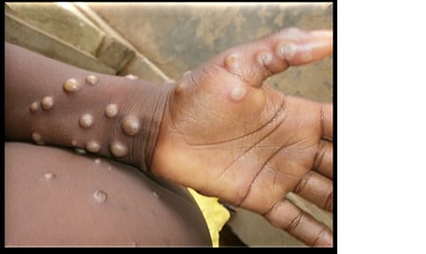 குரங்கு அம்மை