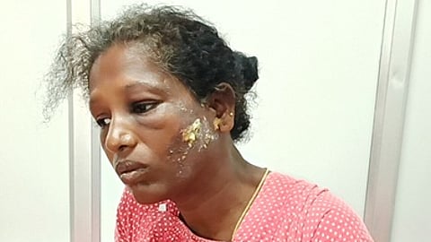 மணப்பாறை அரசு மருத்துவமனையில் சிகிச்சை பெற்று வரும் சரோஜா.