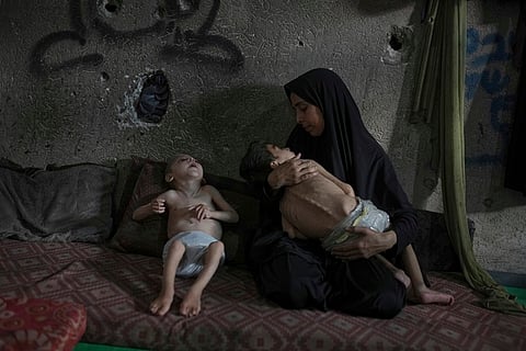 Gaza Malnutrition related deaths cross 300