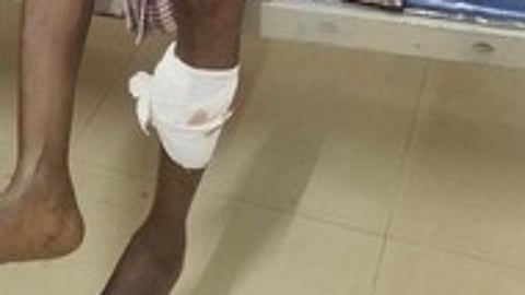 திருச்செந்தூா் அருகே நாய் கடித்து பள்ளி மாணவா்கள் உள்பட 14 போ் காயம்