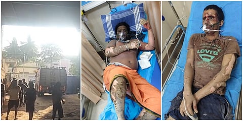 மேட்டூர் அருகே சிட்கோ தொழிற்பேட்டை ரசாயன தொட்டியில் ஏற்பட்ட வெடி விபத்தில் பலத்த காயங்களுடன் சேலம் மருத்துவமனையில் அனுமதிக்கப்பட்டு சிகித்தை பெற்று வரும் தொழிலாளர்கள்.