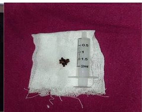 திருச்சி அரசு மருத்துவமனையில் குழந்தையின் மூச்சுக்குழாயிலிருந்து அகற்றப்பட்ட பாக்கு.