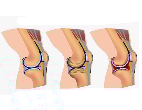 மூட்டு வலியினால் அவதிப்படுபவர்களுக்கு நிவாரணம் தரும் கசாயம்