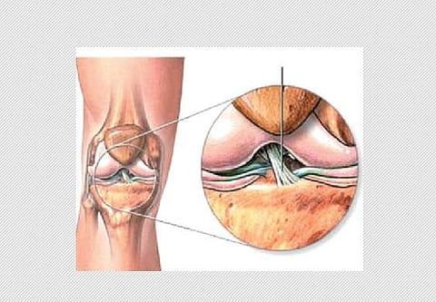 மூட்டுச் சவ்வு பிய்ந்து போனால்...!