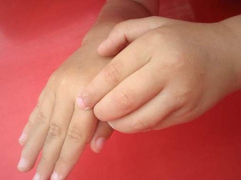 குளிர்காலத்தில் "சொரியாஸிஸ்' ஏற்படாமல் தடுப்பது எப்படி?