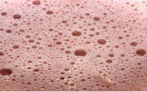 இந்த நோய் உங்களுக்கும் இருக்கலாம்!