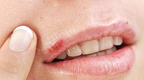 ஆயுள் காக்கும் ஆயுர்வேதம்: உதடுகளில் வறட்சி!