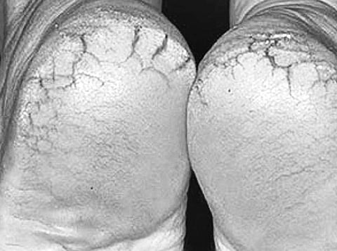 பித்த வெடிப்புக்கு தீர்வு! ஆயுள் காக்கும் ஆயுர்வேதம்