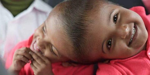 ஒட்டிப் பிறந்த பங்களாதேஷ் இரட்டையர்கள் பிரிக்கப்பட்டது எப்படி? சில்லரிக்கும் தகவல்கள்