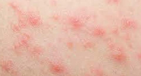 skin diseases