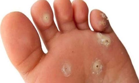 கால் ஆணியைக் குணப்படுத்த உதவும் அற்புத கசாயம்