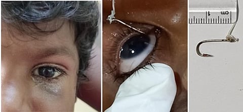 சிறுமியின் கண்ணில் இருந்து அகற்றப்பட்ட தூண்டில் முள்.