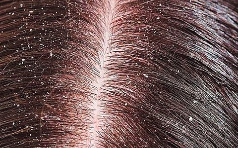 ஆயுள் காக்கும் ஆயுர்வேதம்: பேனையும், ஈறையும் போக்கும் தைலம்!