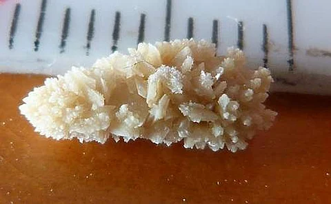 சிறுநீரகக்கல்