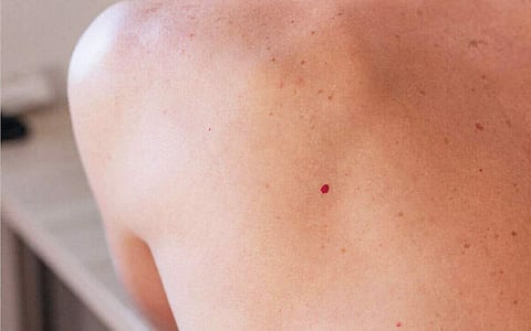 ஆயுள் காக்கும் ஆயுர்வேதம்: முகம், கன்னங்களில் சிவப்பு மச்சங்கள் குணமாக?