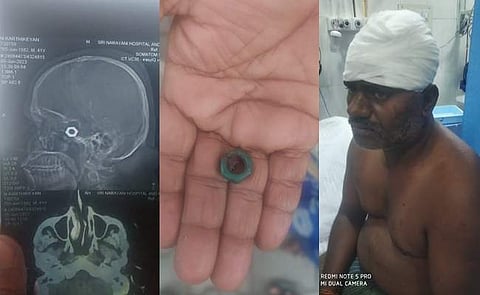 தலைக்குள் போல்ட்டை அகற்றாமல் தையல்: வேலூர் அரசு மருத்துவமனையில் அதிர்ச்சி!