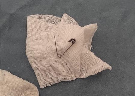 குழந்தையின் தொண்டையிலிருந்து அகற்றப்பட்ட ஊக்கு.