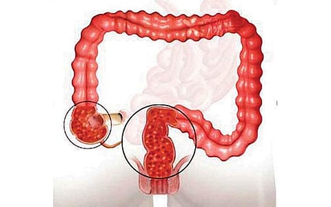 ஆயுள் காக்கும் ஆயுர்வேதம்: பெருங்குடல் அழற்சிக்கு தீர்வு என்ன?