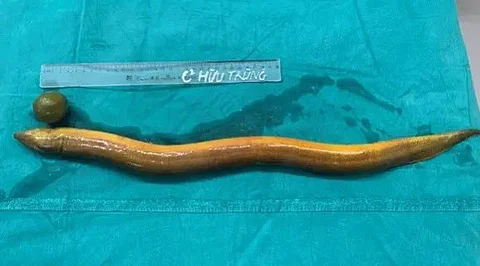 அறுவை சிகிச்சையில் அகற்றப்பட்ட மீன் மற்றும் எலுமிச்சை. 