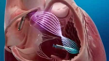 நோயாளிக்குப் பொருத்தப்பட்ட பேஸ்மேக்கா்.