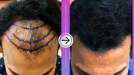 போலி மருத்துவா்கள் மூலம் முடி மாற்று சிகிச்சை: கண்காணிப்பதில் நிலவும் சிக்கல்