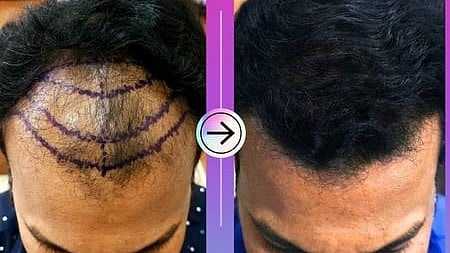 முடி மாற்று சிகிச்சை