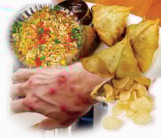 ஆயுள் காக்கும் ஆயுர்வேதம்: சமோஸô... சிப்ஸ்... பேல்பூரி... தோல்நோய்