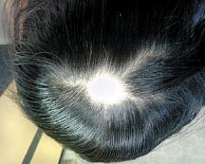 ஆயுள் காக்கும் ஆயுர்வேதம்: தலையில் புழு வெட்டு!