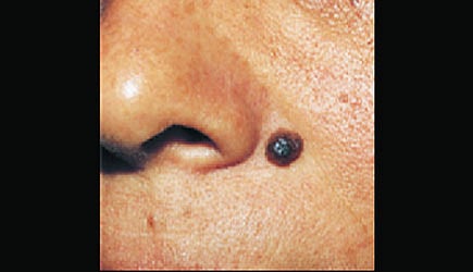 ஆயுள்காக்கும் ஆயுர்வேதம்: முகத்தில் ஏற்படும் கறுப்பு உருண்டை!