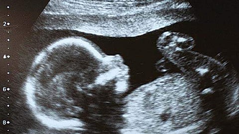 கருவிலேயே அழிக்கப்படும் பெண் சிசுக்கள்: துணைபோகும் மருத்துவர்கள்