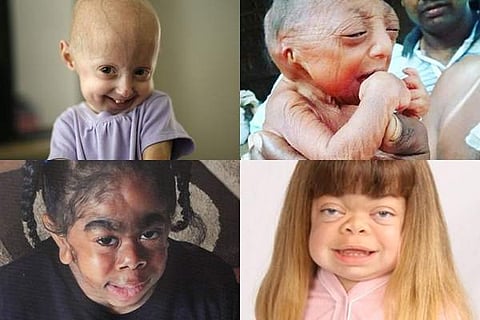 குழந்தைகளைத் தாக்கும் தீர்க்கமுடியாத சில அரிய நோய்கள்!