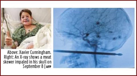 மூக்கில் குத்தி பின்கழுத்தில் வெளியே வந்த ஸ்பூன்: உயிர் பிழைத்த அதிசய சிறுவன்