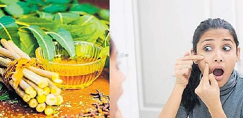 முகப்பரு பிரச்னையா? கண்ட கண்ட கிரீம்களை போடாதீங்க!