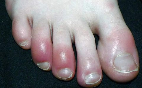 கால்விரல்கள் சிவப்பதும் கரோனாவின் அறிகுறியா? 