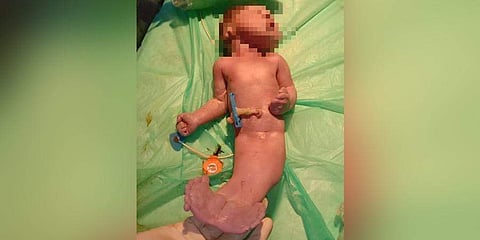 மீன் போன்ற உடலுடன் பிறந்த குழந்தை: 2 மணி நேரத்தில் உயிரிழப்பு