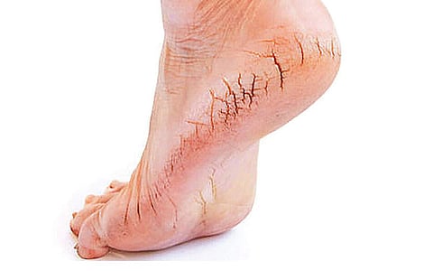 ஆயுள் காக்கும் ஆயுர்வேதம்: தோல் வறட்சி... குதிகால் வெடிப்பு!