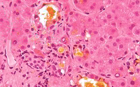 ஆயுள் காக்கும் ஆயுர்வேதம்: பித்தநீர் அதிகம் சுரப்பதை தடுக்க ...