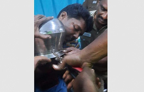 குழந்தையின் தலையில் சிக்கிய பாத்திரத்தை லாவகமாக வெட்டி எடுக்கும் மருத்துவர்கள்