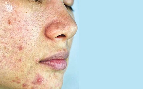 ஆயுள் காக்கும் ஆயுர்வேதம்: ரத்தம் கெடுதல்... தோலில் பிரச்னை!