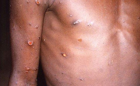 ரஷியாவில் முதல் குரங்கு அம்மை பாதிப்பு உறுதி