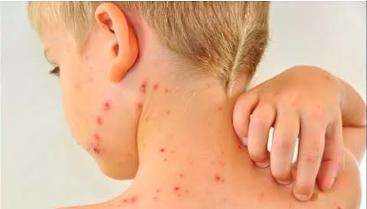 கேரளத்தில் 75 நாள்களில் 6,744 பேருக்கு அம்மை நோய் பாதிப்பு, 9 பேர் பலி