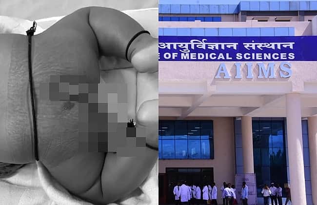 வாலுடன் பிறந்த குழந்தை! உலகில் 41வது அறுவை சிகிச்சை!