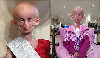 அரிய நோயால் பாதிக்கப்பட்ட 19 வயது டிக்-டாக் பிரபலம் மரணம்!