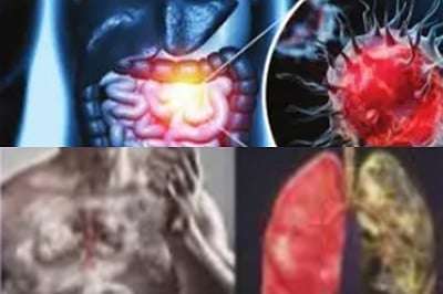 புற்றுநோய்...  தொடக்கத்தில் வைப்போம் முற்றுப்புள்ளி