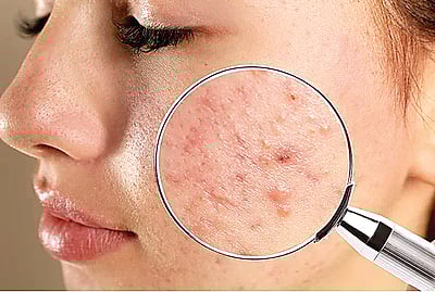 முகப்பருவை அகற்ற...