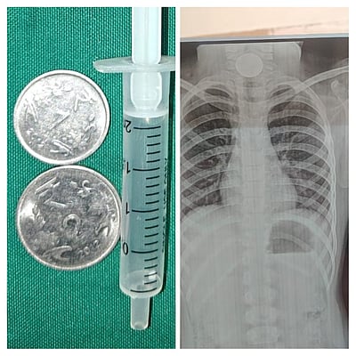 இரு காசுகளை விழுங்கிய 2 ஆம் வகுப்பு மாணவி! விரைந்து செயல்பட்டுக் காப்பாற்றிய அரசு மருத்துவர்கள்! 