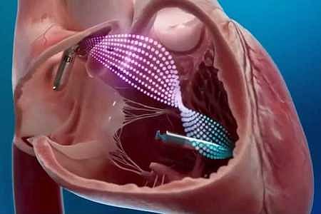 ஒயா் இல்லாத பேஸ்மேக்கா் பொருத்தி கேஎம்சிஹெச்
மருத்துவமனை மருத்துவா்கள் சாதனை!