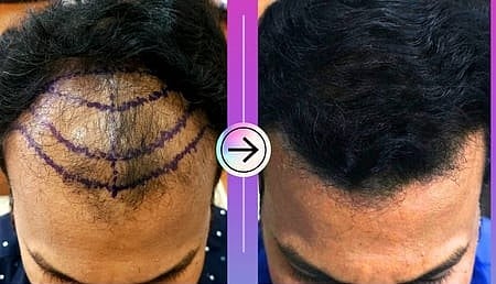 போலி மருத்துவா்கள் மூலம் முடி மாற்று சிகிச்சை: கண்காணிப்பதில் நிலவும் சிக்கல்