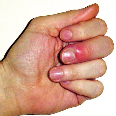 ஆயுள் காக்கும் ஆயுர்வேதம்: நகச் சுற்று குணமாக...